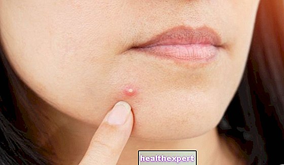 Giant pimples: causes and treatment of this XXL size blemish!