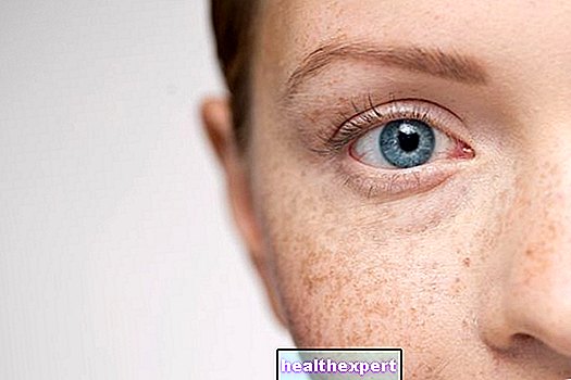 Зърна от просо: как да премахнете малки кисти около очите