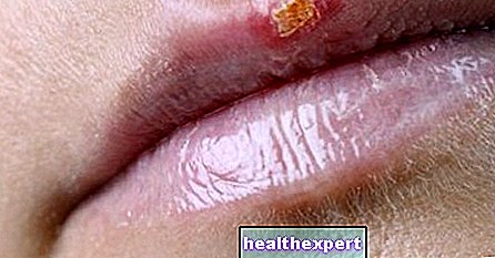Herpes labial: conócelo y luche contra él