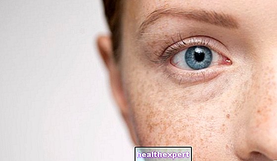 Võltsitud freckles: 5 võimalust hetke trendi loomiseks näol - Ilu