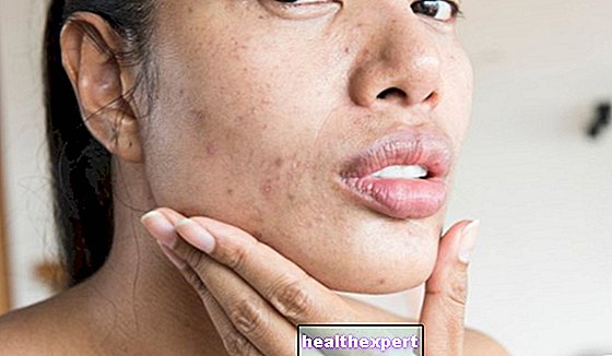 Spuogelių dėmės: raudonų spuogų atsiradimo ant veido ir kūno priežastys, gydymas ir gydymas