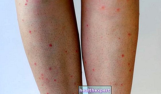 Κόκκινες κουκίδες στα πόδια: όλες οι αιτίες της εμφάνισής τους και οι θεραπείες για την επίλυση του προβλήματος!