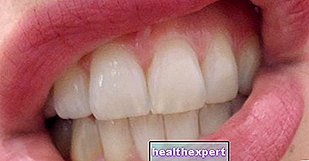 Atjaunojiet, inovatīvais zobu emaljas komplekts, ko esam izmēģinājuši jums