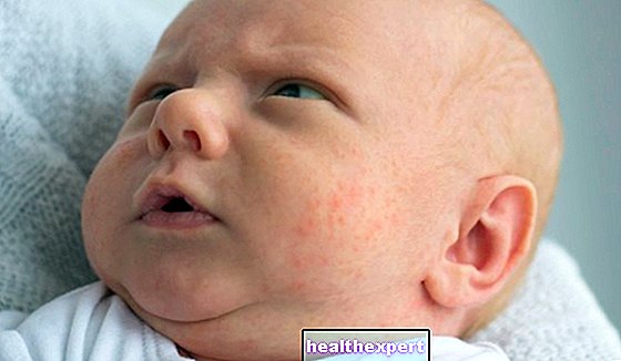U novorodencov pupienky: príčiny a prostriedky pre neonatálne akné