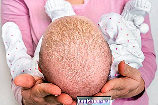 Rodičovstvo - Cradle cap: symptómy a liečba seboroickej dermatitídy postihujúcej kožu novorodenca