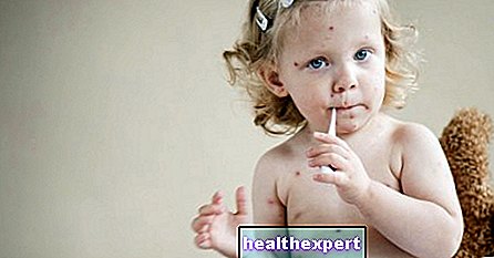 子供のはしか：症状、治療、ワクチン