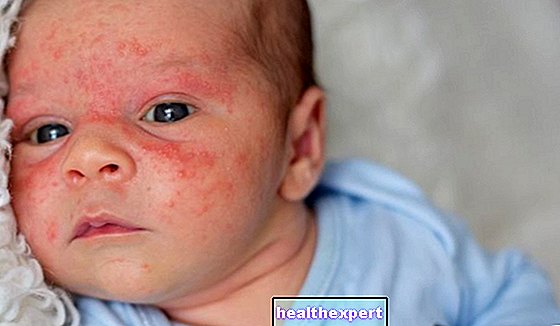 Red spots on the newborn's skin: dermatitis, neonatal acne or sixth disease?