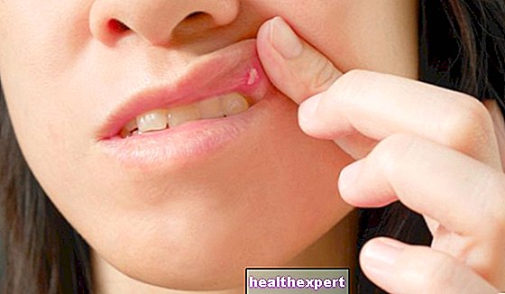 How to get rid of canker sores fast: heal mouth ulcers naturally and super quickly and achieve complete healing
